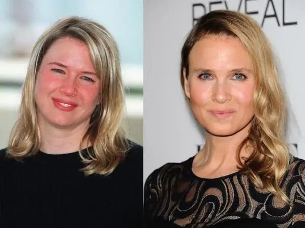 renee zellweger plastic surgery